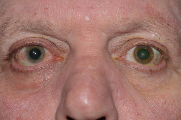 Iris heterochromia in a patient with Fuchs' Heterochromic Iridocyclitis. Note the lighter colored iris in the affected right eye.