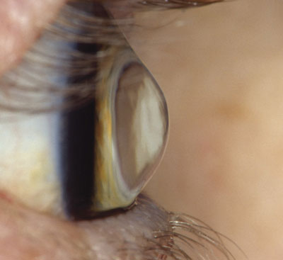 Lateral view of a keratoconic eye