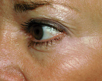 Photograph of eye wrinkles after Botox