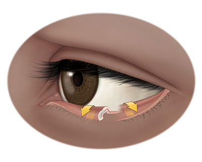 Illustration of lower eyelid with ectropion, or lower eyelid that turns outward