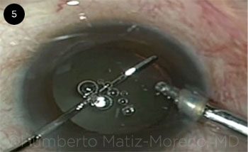 Topical steroids after cataract surgery