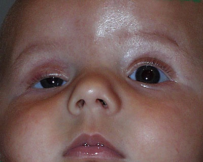 Photograph of small child with ptosis of right eye