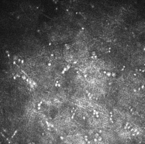 Figure 6. Acanthamoeba
cysts can be seen on in vivo
confocal microscopy.