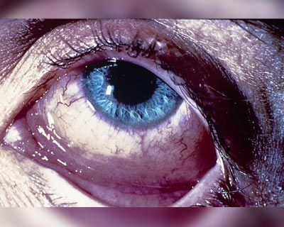 Acercamiento de un ojo con ojo rojo (conjuntivitis) alérgica. El ojo está rojo y irritado.