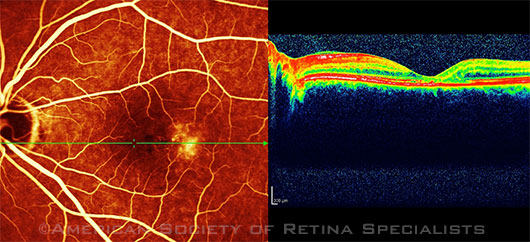Scanning laser ophthalmoscopy and SD-OCT of a 56-year-old woman with MacTel2.