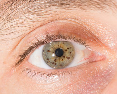 These freckles of the eye are called iris nevi. A nevus (singular) in the colored part of the eye is not uncommon.
