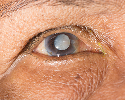 Close-up photo of an elderly man's cataract