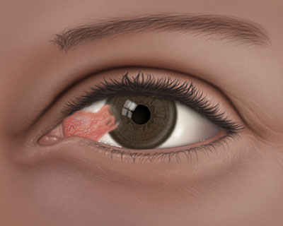 Illustration of an eye with a Pterygium