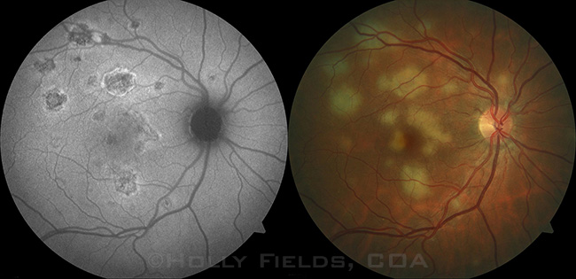 Acute Posterior Multifocal Placoid Pigment Epitheliopathy