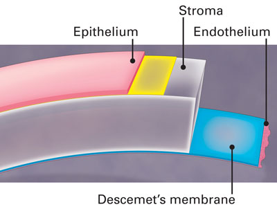 Diagram of Epithelium, Stroma, Endothelium and Descemet's membrane in th eye