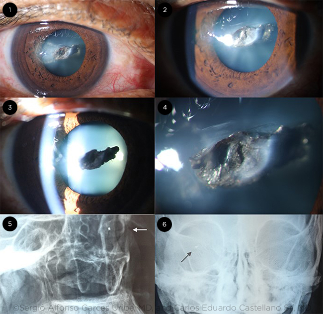 Traumatic Cataract by Foreign Body