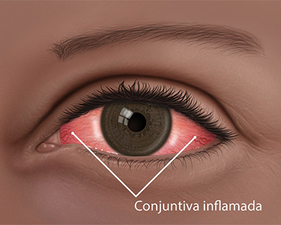 Conjuntiva inflamada de ojo rojo
