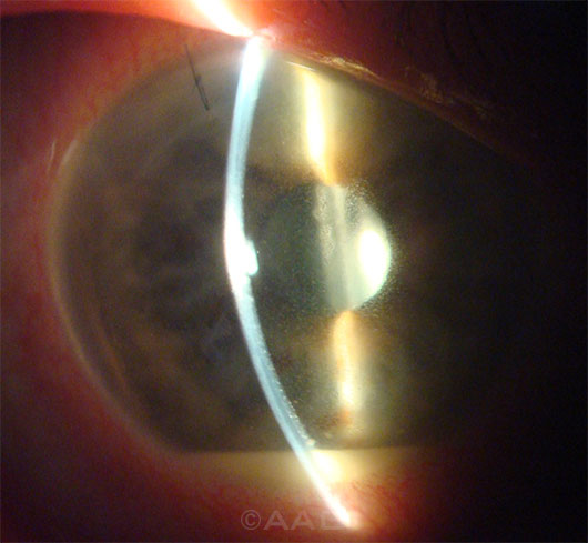 A large U.S. study corroborates earlier findings that endophthalmitis, like this case seen 4 days after cataract surgery, can be significantly reduced with intracameral antibiotics.