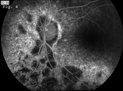 Fluorescein Angiography 2