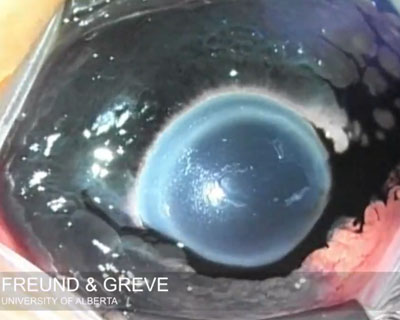 Surgical image of patient undergoing treatment for a problematic eyeball tattoo.