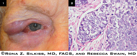 Sebaceous Carcinoma of the Eyelid