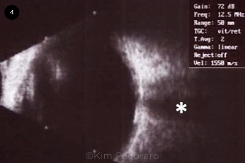 Ultrasound B Scan of the Right Eye
