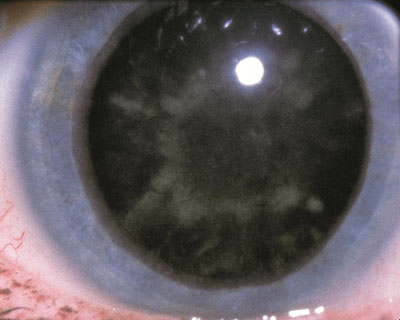 Diabetic cataract, or “snowflake” cataract seen, in rare cases, in patients with uncontrolled diabetes mellitus.