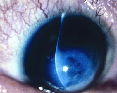 Close up of eye with keratoconus, illuminated during exam.