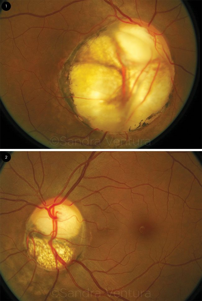 Colobomas of the Optic Nerve
