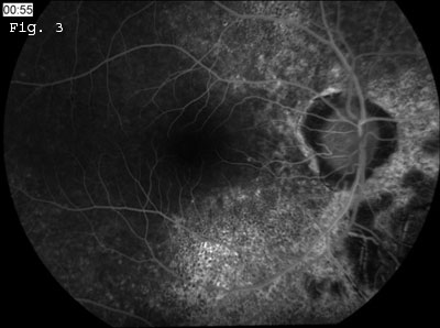 Fluorescein Angiography 1