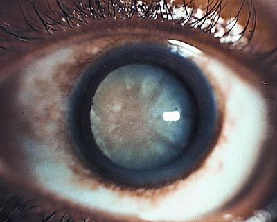 Una catarata – un cristalino opacificado detrás de la pupila – visto en un ojo adulto.