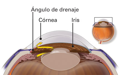 ángulo de drenaje bloqueado - glaucoma