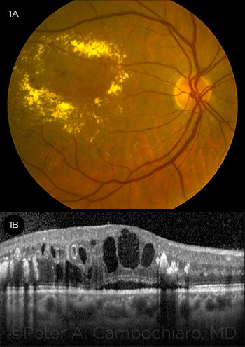 Diabetic Macular Edema—Personalizing Treatment - American Academy of