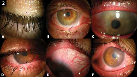 Ocular manifestations of Demodex infestation