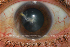 Central Corneal Herpetic Stromal Scar With Neovascularization