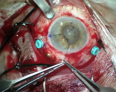Pvr And Retinal Detachment Repair American Academy Of Ophthalmology