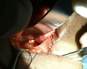 Orbital Floor Fracture Repair With Placement Of Implant American