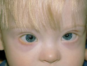 Down Syndrome Trisomy 21 American Academy Of Ophthalmology