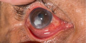 Imagen de una úlcera corneal o una llaga abierta en la ventana frontal transparente del ojo