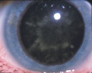 Diagnose This: Early cataract formation in diabetes mellitus - American