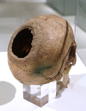 The back of a human skull with a large, circular hole bored into it. The skull sits, facing backwards, in a white case and resting on a clear, plastic cube.