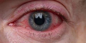 Red Eye Detection