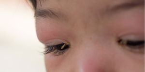 Un ojo con blefaritis tiene un párpado rojo e irritado y una secreción crujiente en las pestañas.