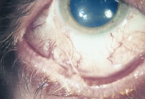 symblepharon inferior ocular result cicatricial pemphigoid