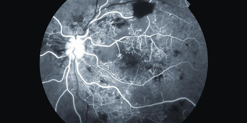 Black and white, high-contrast retinal image of eye with proliferative diabetic retinopathy.