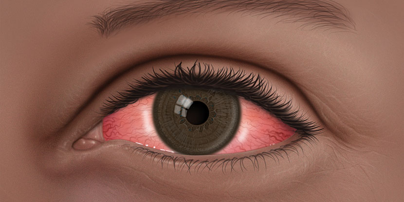 Pink eyes are symptoms of pink eye, or conjunctivitis