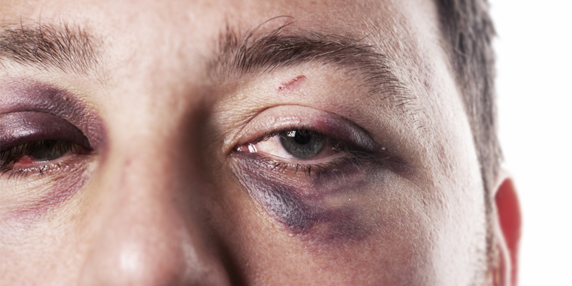 Closeup image of man with injured eyes. An ophthalmologist should examine eye injuries as soon as possible.