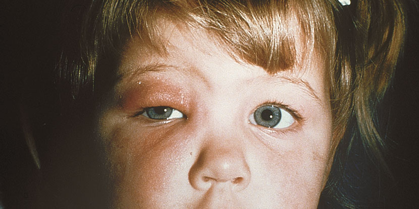 A photograph of a young girl with cellulitis, an infection that has caused her eyelid to swell