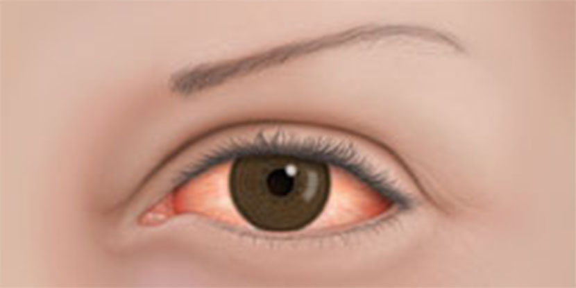 Ilustrado, imagen de portarretrato de un ojo rojo inflamado debido a alergias.