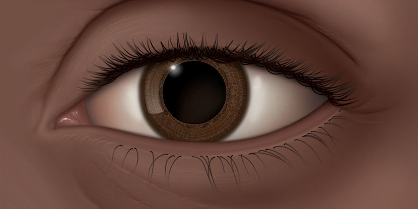 Ilustración de un ojo izquierdo dilatado, que carece de la respuesta pupilar normal a la luz