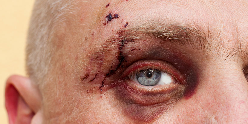 Man with black eye and eye injury.