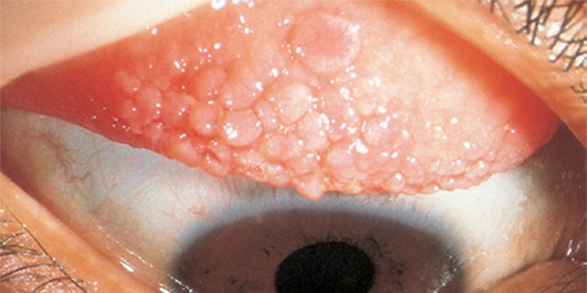 El interior de un párpado con conjuntivitis papilar gigante está rojo, inflamado e irritado.
