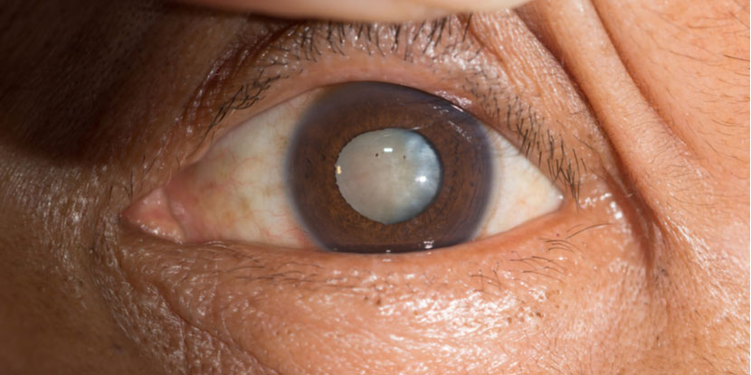 Acercamiento de una catarata madura o avanzada en el ojo de un adulto mayor