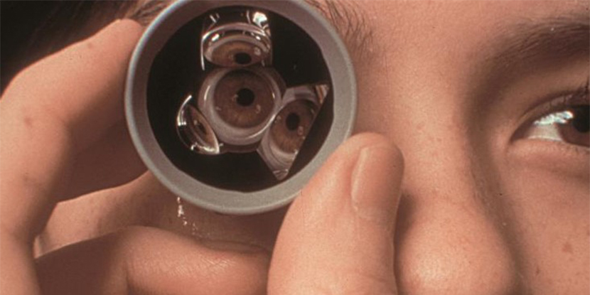 Un lente especial que se sostiene sobre el ojo de un paciente para un examen de gonioscopia