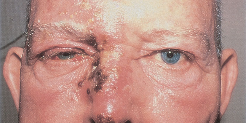 Photo of a mature man with a rash of shingles, or herpes zoster blisters on his nose, right eyelid, and forehead